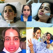 Moments after undergoing a lip filler treatment, Urfi Javed found herself  in unbearable pain, resulting in an emergency hospitalization. A video of  her crying has gone viral, raising questions about the risks