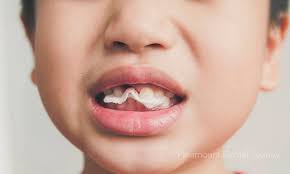 How do you know if you get dry socket. The Trouble With Dry Socket Paramount Dental Sydney
