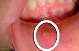 Aphthen / aphten sind nicht ansteckend, daher erfolgt die behandlung der schmerzen ausschließlich symptomatisch. Hausmittel Gegen Aphthe Im Mund Gesundheit Aphten