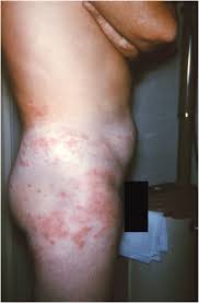 Image result for Trombicula autumnalis bites