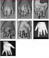 Image result for Syndactyly