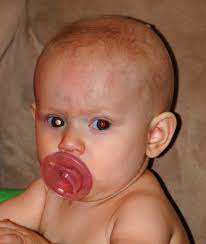 It often presents with nonspecific symptoms similar to those of benign conditions, leading to delays in the diagnosis and initiation of appropriate treatment. Photored Know The Glow And Check For Normal Red Eye Reflex In Children We C Hope