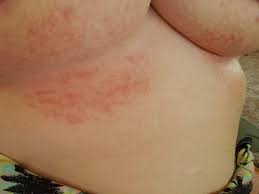 Image result for heat rash under breasts