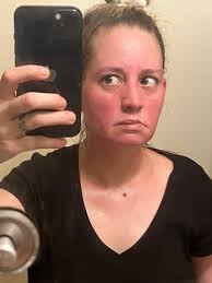 Has anyone had an odd gait due to lupus?