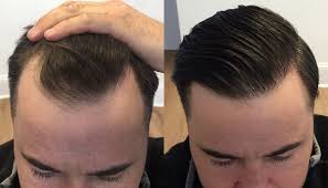 Hair Transplant How Long Do They Last In 2020 Hair Transplant Hair Transplant Surgery Hair Transplant Cost