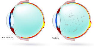 Image result for Floaters