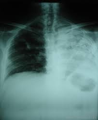 Pleural effusions may result from pleural, parenchymal, or extrapulmonary disease. What Is Bilateral Pleural Effusion With Pictures