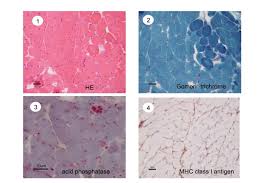 Image result for Myopathy