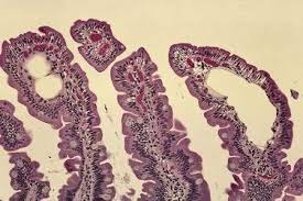 Image result for Intestinal Enteropathy