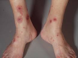 Image result for Trombicula autumnalis bites