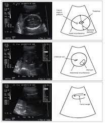 Intrauterine Growth Restriction Identification And