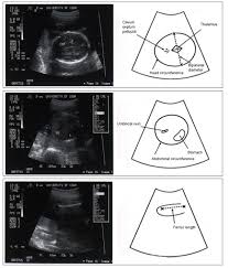 Intrauterine Growth Restriction Identification And