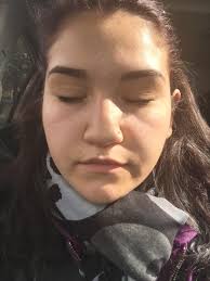 How do you reduce cheek fat? What Are These Lines On My Cheeks And How Do I Get Rid Of Or Lessen Them Photo