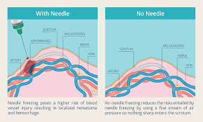 Check spelling or type a new query. Winnipeg Vasectomy Cost How Much Is A Vasectomy In Mb