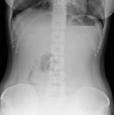 Perforated Appendicitis With Appendicolith Radiology Case Radiopaedia Org Radiopaedia is free thanks to our supporters and advertisers.become a gold supporter and see no ads. perforated appendicitis with