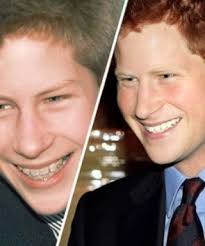 Queen Elizabeth is not the only royal who wore braces — many of her  grandchildren sported the look during their adolescence. Prince Harry &  Prince William- both brothers wore braces in their