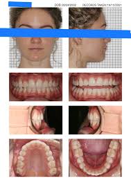 Mid-face development and dental alignment