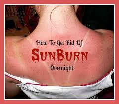 How To Get Rid Of A Sunburn Overnight Operation 40k Sunburn Remedies Best Sunburn Relief Natural Remedies For Sunburn