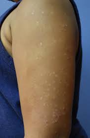 Image result for Photodermatitis