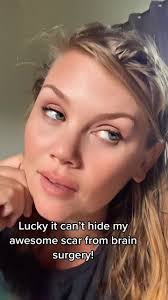 Proud of my battle scars #idiopathicintracranialhypertension #iih #shunt  #vpshunt #brainsurgery #neurosurgery