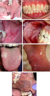 Image result for lichen planus on tongue)