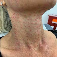 Check spelling or type a new query. Neck And Jawline Rejuvenation Using Botox And Dysport Miami Fl