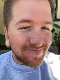 Image result for skin cancer on nose pimple