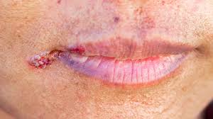 Image result for Angular Stomatitis