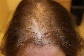 These changes also lead to symptoms like menstrual cycle irregularity, dry skin,. Hair Loss In Women Syracuse Ny Syracuse Female Hair Loss