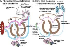 Image result for Delayed Transition from Fetal Circulation