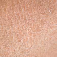 Image result for Dry Skin