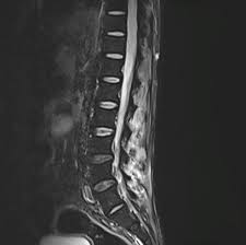 Image result for Myelitis