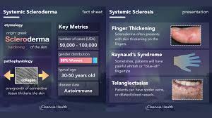 Image result for Systemic Sclerosis