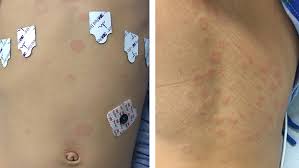 The symptoms can overlap with infections and other illnesses. Experts At Children S Hospital Of Philadelphia Describe Types Of Rashes Associated With Mis C Children S Hospital Of Philadelphia