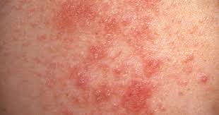 Image result for sweat rash on back