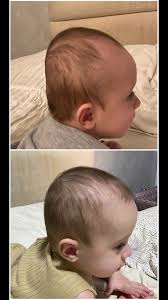 متى نحتاج إلى خوذة طبية لرأس الطفل الطويل من الخلف؟