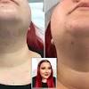 Hirsutism, caused by a hormonal imbalance in women, leads to excessive body hair, acne, a deep voice and more. 1