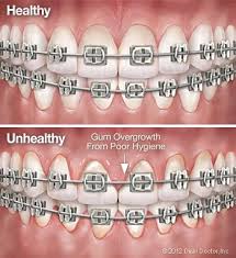 The example above shows different couples on a date, going. 30 Braces Ideas Braces Dental Braces Braces Tips