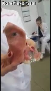 Log into www documentingreality com in a single click. Lyam On Twitter Awesome Magnet Retained Facial Dental Maxillary Prosthesis For A Man With A Rather Large Hole In His Face Amazing What A Difference It Makes See The Video More