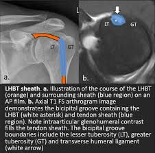 Image result for Biceps Tendon Injection