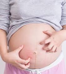 Itchy Belly During Pregnancy Causes Remedies And Treatment