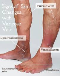 Image result for Lipodermatosclerosis