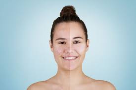 Hair gel is a hairstyling product that is used to harden hair into a particular hairstyle. Differin Gel Uses Side Effects How It Works