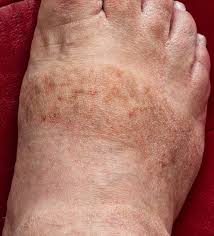 Image result for brown patches on the feet