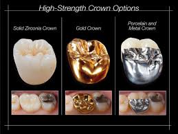 Dental Crowns Dental Caps Crowns Tooth Crowns In Kingston London
