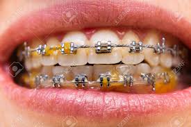 Whether you're looking for affordable braces for your child or simply want to schedule a routine checkup, kool smiles can help parents with all of their dental health questions and concerns. Close Up Teeth With Braces Dental Care Photo Woman Smile With Stock Photo Picture And Royalty Free Image Image 151352196