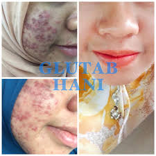 Ada beberapa bahan alami yang dapat anda gunakan untuk menuntaskan masalah jerawat pada kulit. Kisah Kak Lina Hilangkan Jerawat Selepas Mencuba Pelbagai Rawatan Dan Laser Tanpa Merkuri Kisah Kak Lina Hilangkan Jerawat Selepas Mencuba Pelbagai Rawatan