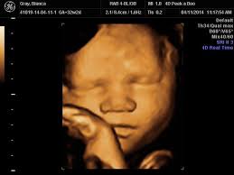 A Peek In To The Womb Baby Orion Crystal Clear Love This Little Face Baby Fever Orion Ultrasound