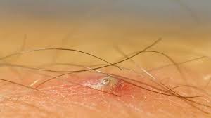 Ingrown hair removal treatment may be necessary if the ingrown hair does not dislodge on its own and is causing uncomfortable symptoms or infection. Ingrown Hair On Penile Shaft Removal Identification And Causes