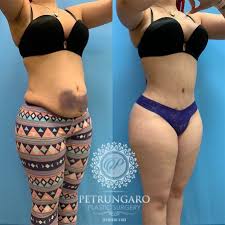 27 Woman After Tummy Tuck W Lipo 360 Petrungaro Plastic Surgery